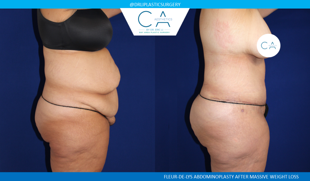 Tummy Tuck case #8495