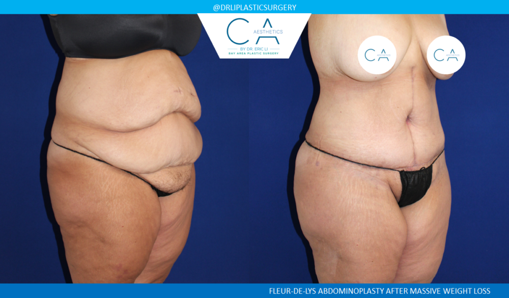 Tummy Tuck case #8495