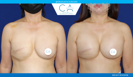 Breast Revision case #8459