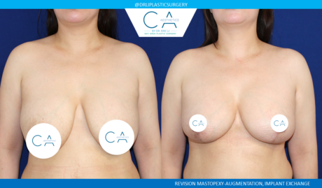 Breast Revision case #8461