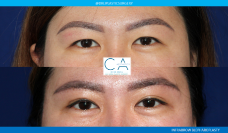 Asian Eyelid case #8400