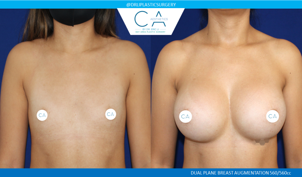 Breast Augmentation case #8417