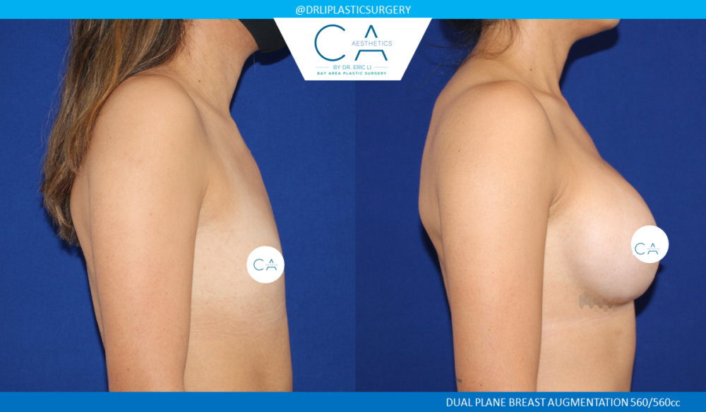 Breast Augmentation case #8417