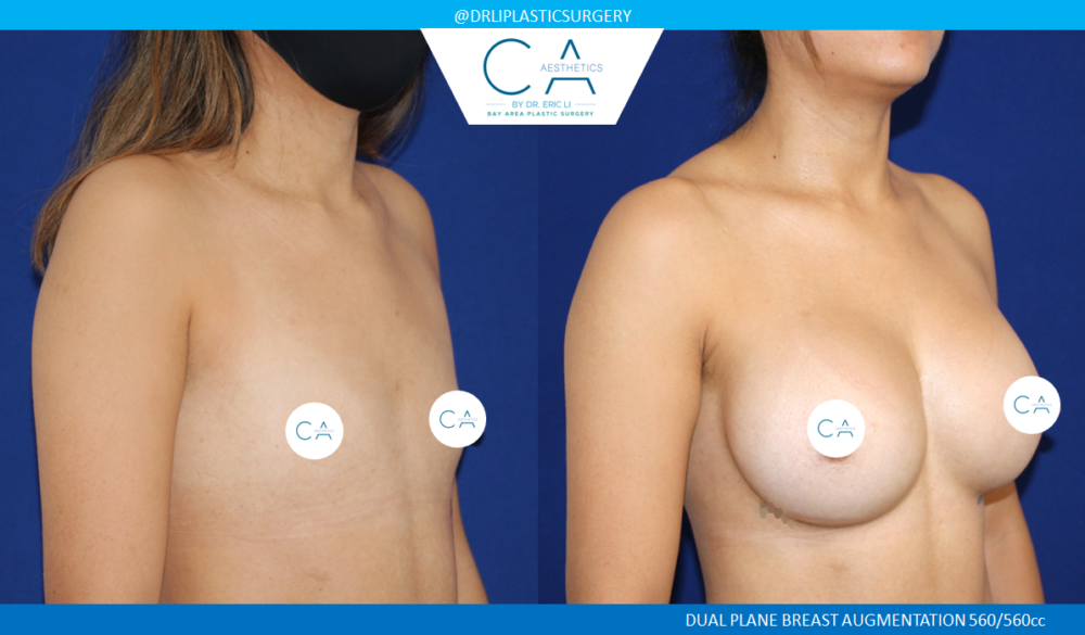 Breast Augmentation case #8417