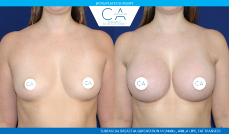 Breast Augmentation case #8421