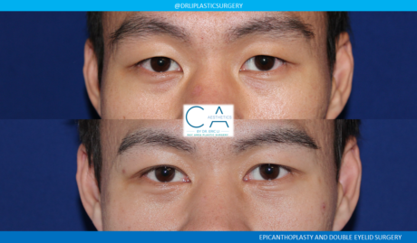 Asian Eyelid case #8389