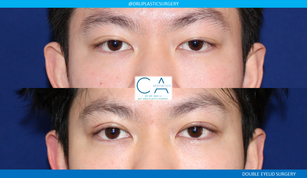 Asian Eyelid case #8520