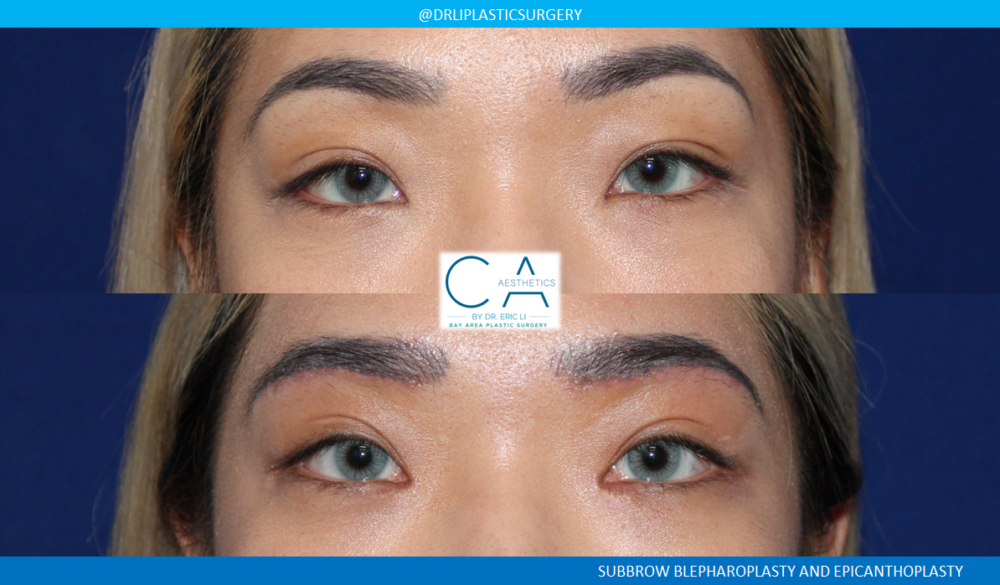 14-Asian-Eyelid-Surgery-AP-1000×585