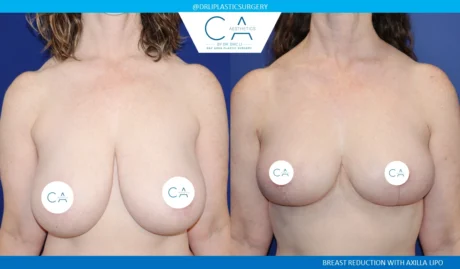 Breast Reduction case #8802