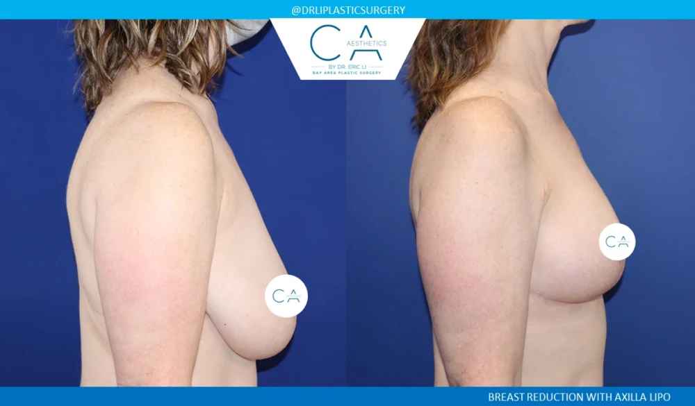 Breast Reduction case #8802