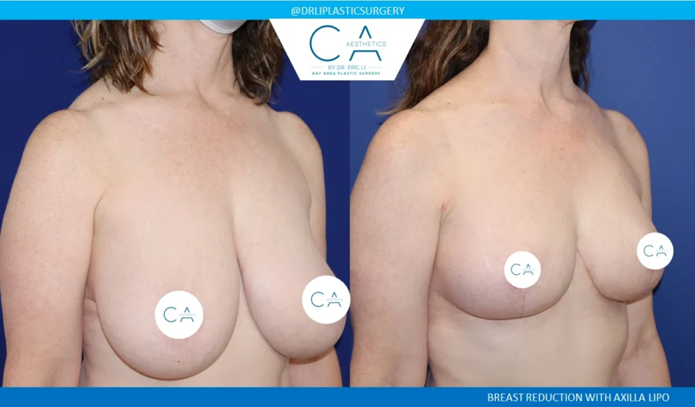 Breast Reduction case #8802