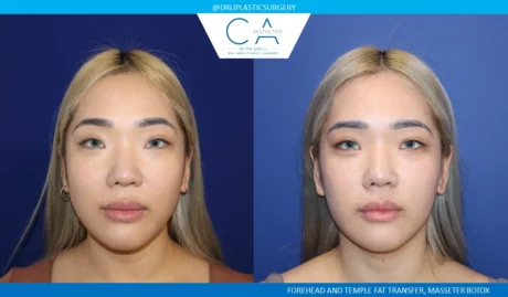Facial Implants and Fat Transfer case #8737