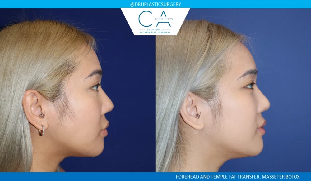 Facial Implants and Fat Transfer case #8737