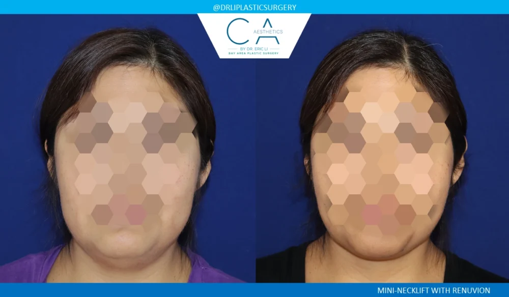 Neck Lift case #8708
