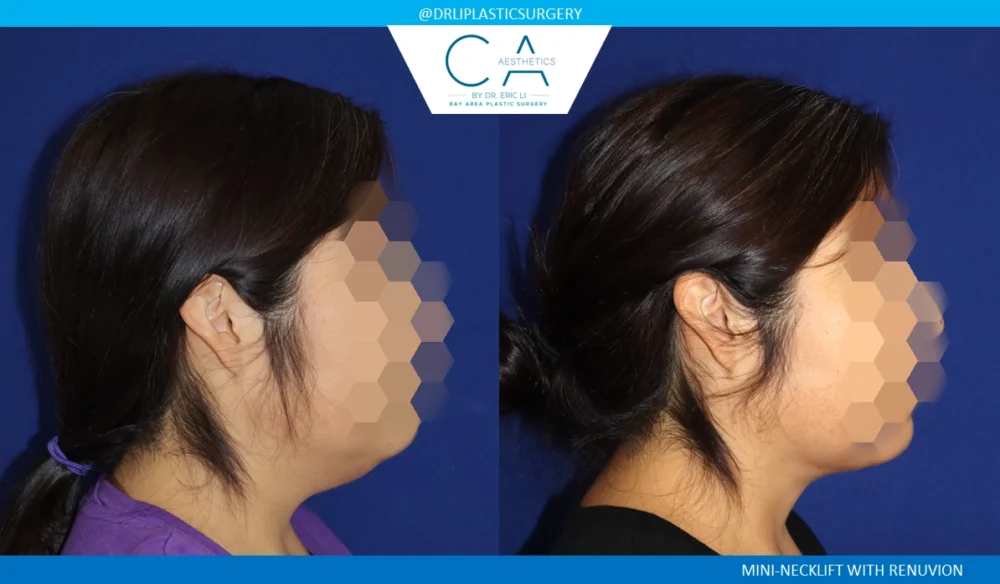 Neck Lift case #8708