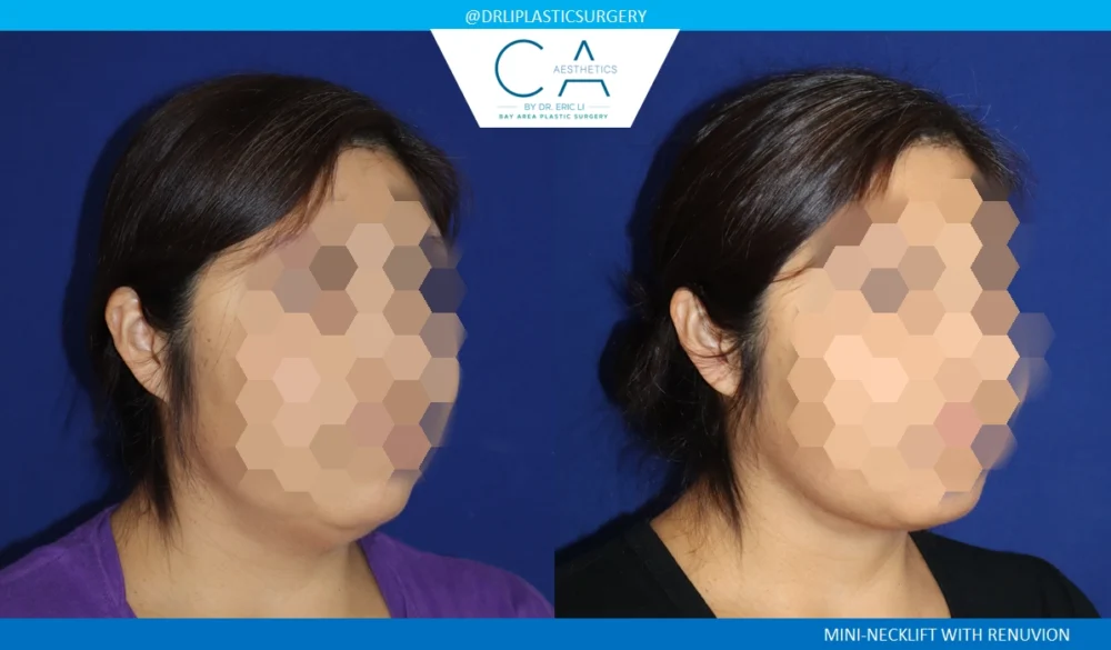 Neck Lift case #8708