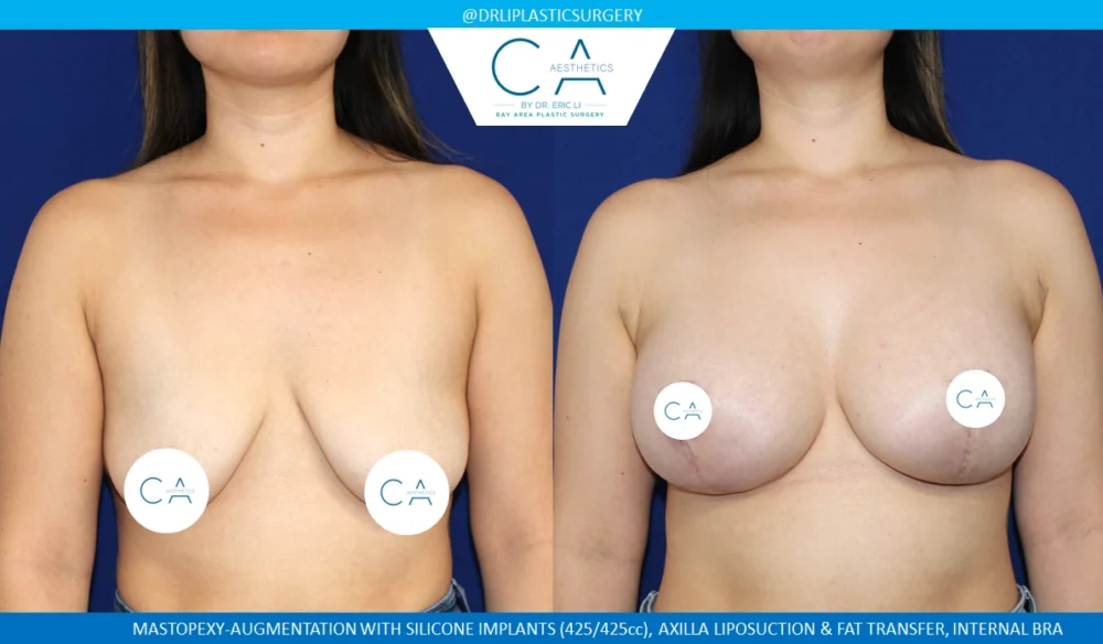 Tuberous Breast Correction case #8751