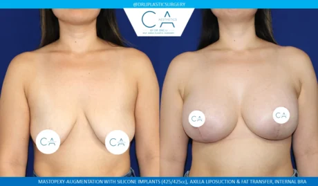 Tuberous Breast Correction case #8751