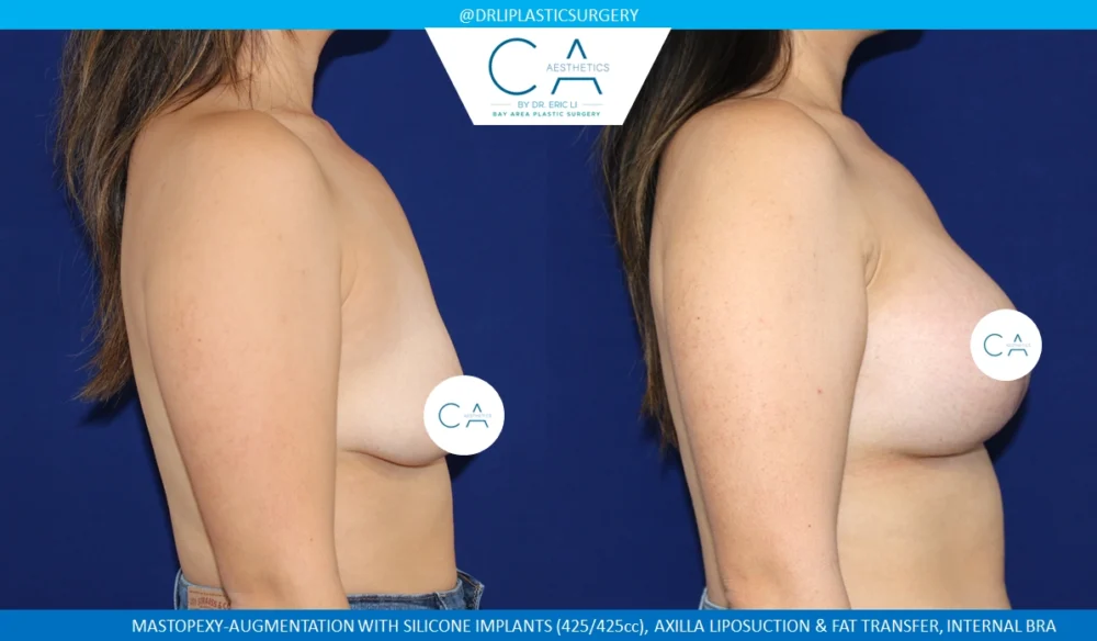 Tuberous Breast Correction case #8751