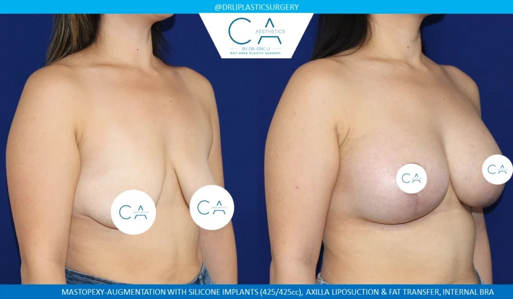 Tuberous Breast Correction case #8751