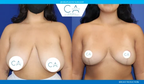 Breast Reduction case #8801