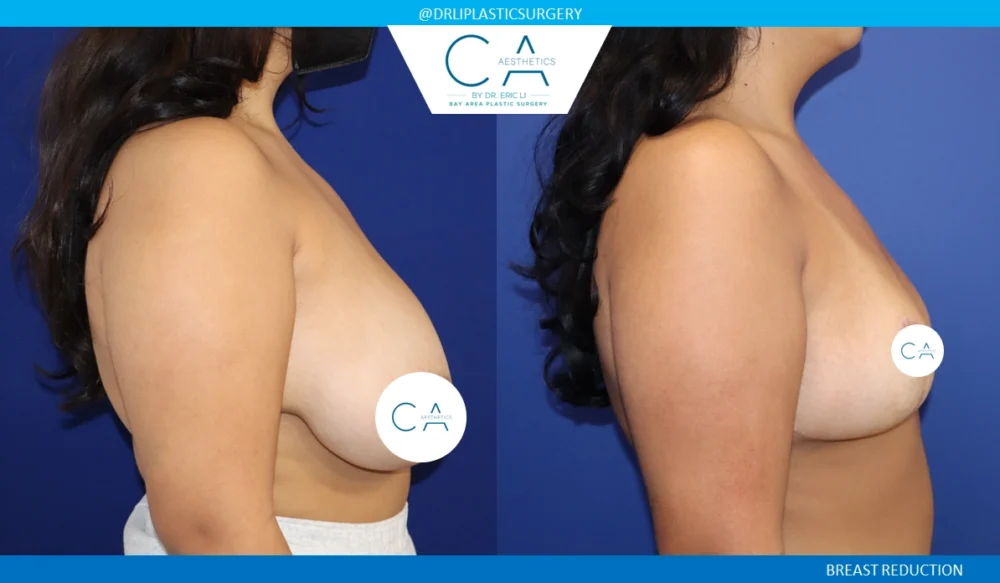 Breast Reduction case #8801