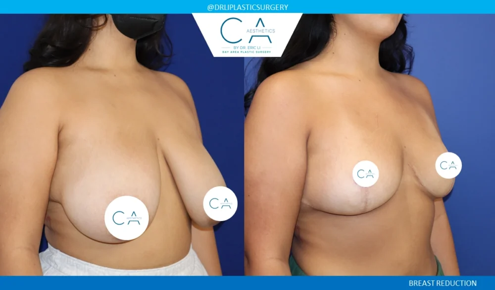 Breast Reduction case #8801