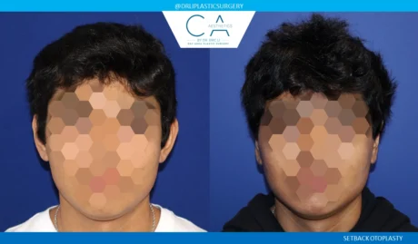 Otoplasty (Ear Surgery) case #8704