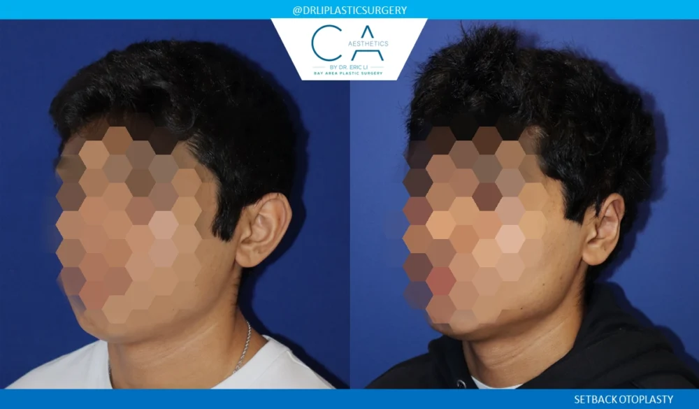 Otoplasty (Ear Surgery) case #8704