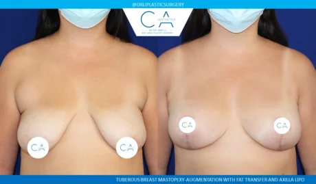 Tuberous Breast Correction case #8755