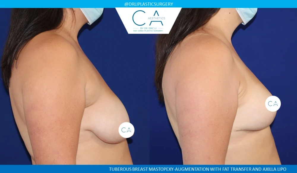 Tuberous Breast Correction case #8755