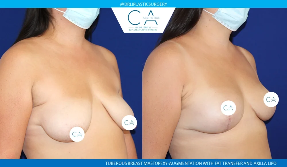 Tuberous Breast Correction case #8755