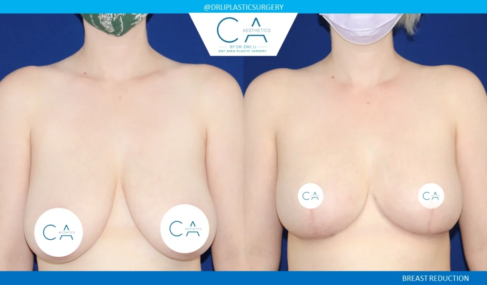 Breast Reduction case #8789