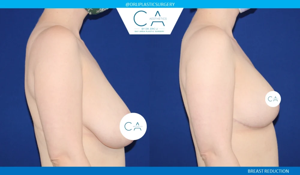 Breast Reduction case #8789