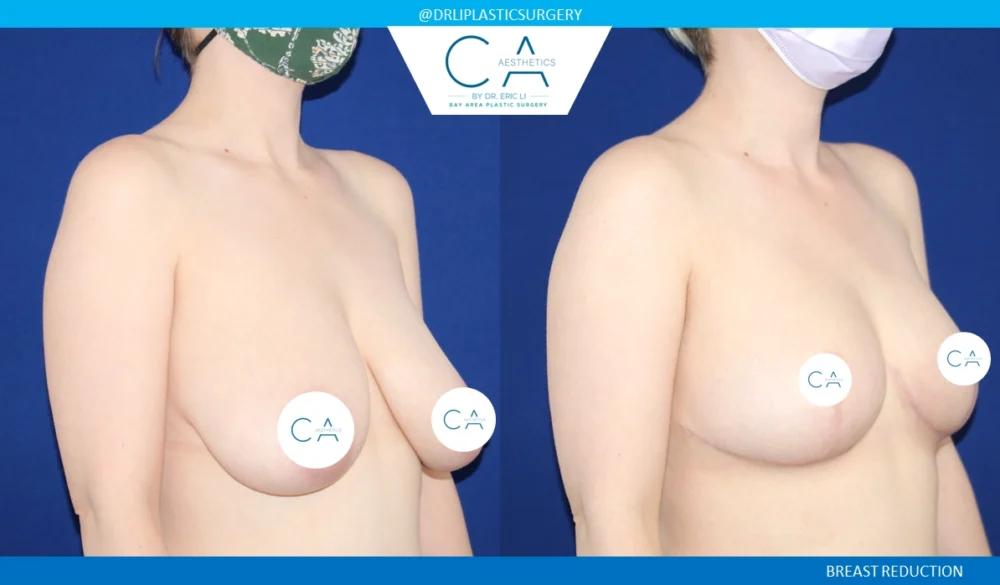 Breast Reduction case #8789