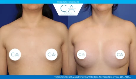 Tuberous Breast Correction case #8759