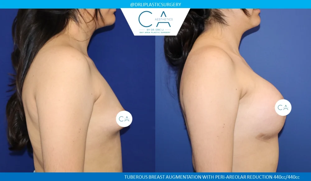 Tuberous Breast Correction case #8759