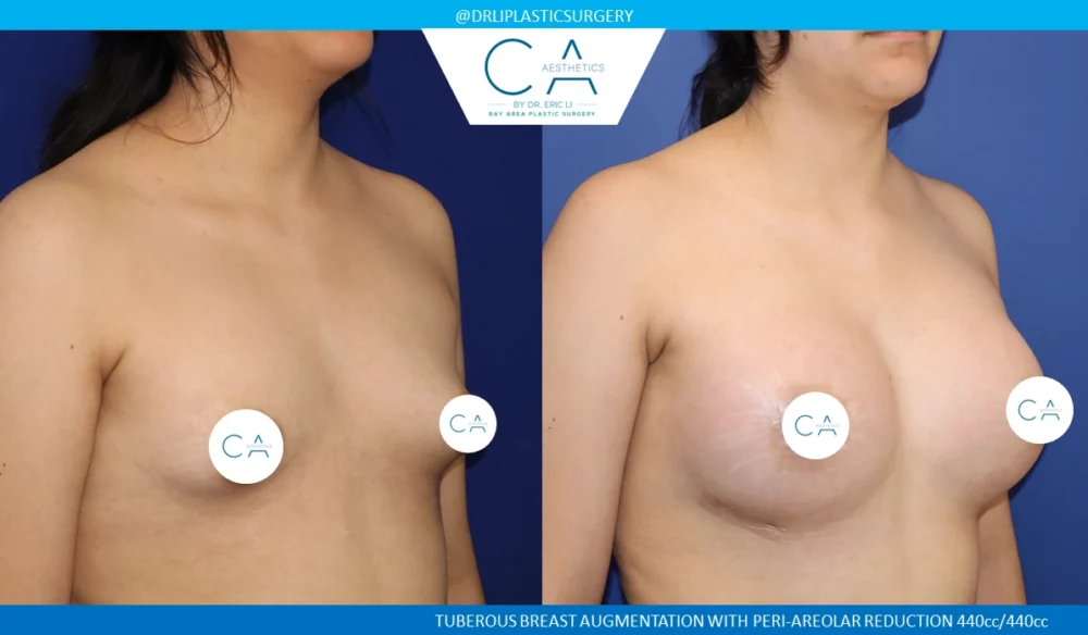 Tuberous Breast Correction case #8759