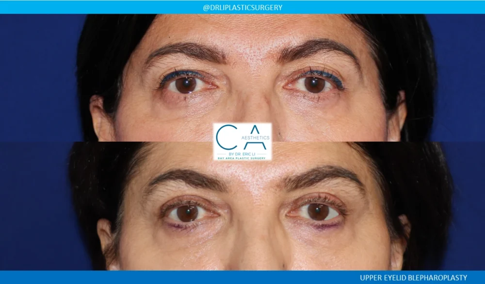 Upper Blepharoplasty case #8741