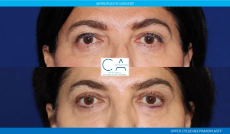 Upper Blepharoplasty case #8741