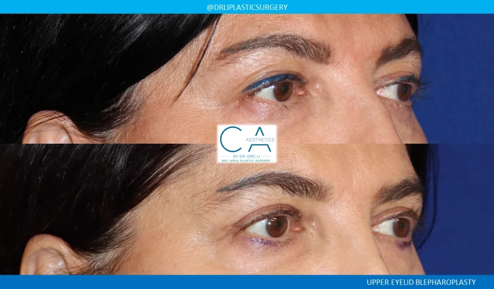 Upper Blepharoplasty case #8741
