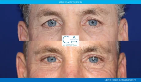 Upper Blepharoplasty case #8748