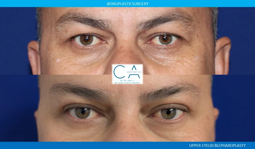 Upper Blepharoplasty case #8749