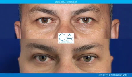Upper Blepharoplasty case #8749