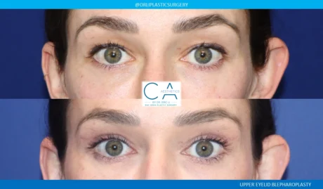 Upper Blepharoplasty case #8750