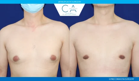 Gynecomastia case #8733