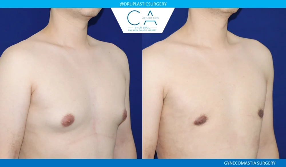 Gynecomastia case #8733