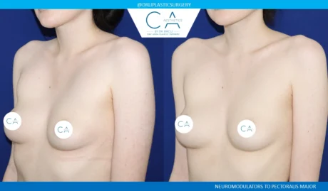 Botox case #8818
