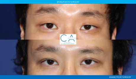 Asian Eyelid case #8676