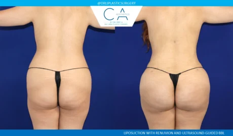 Brazilian Butt Lift case #8678